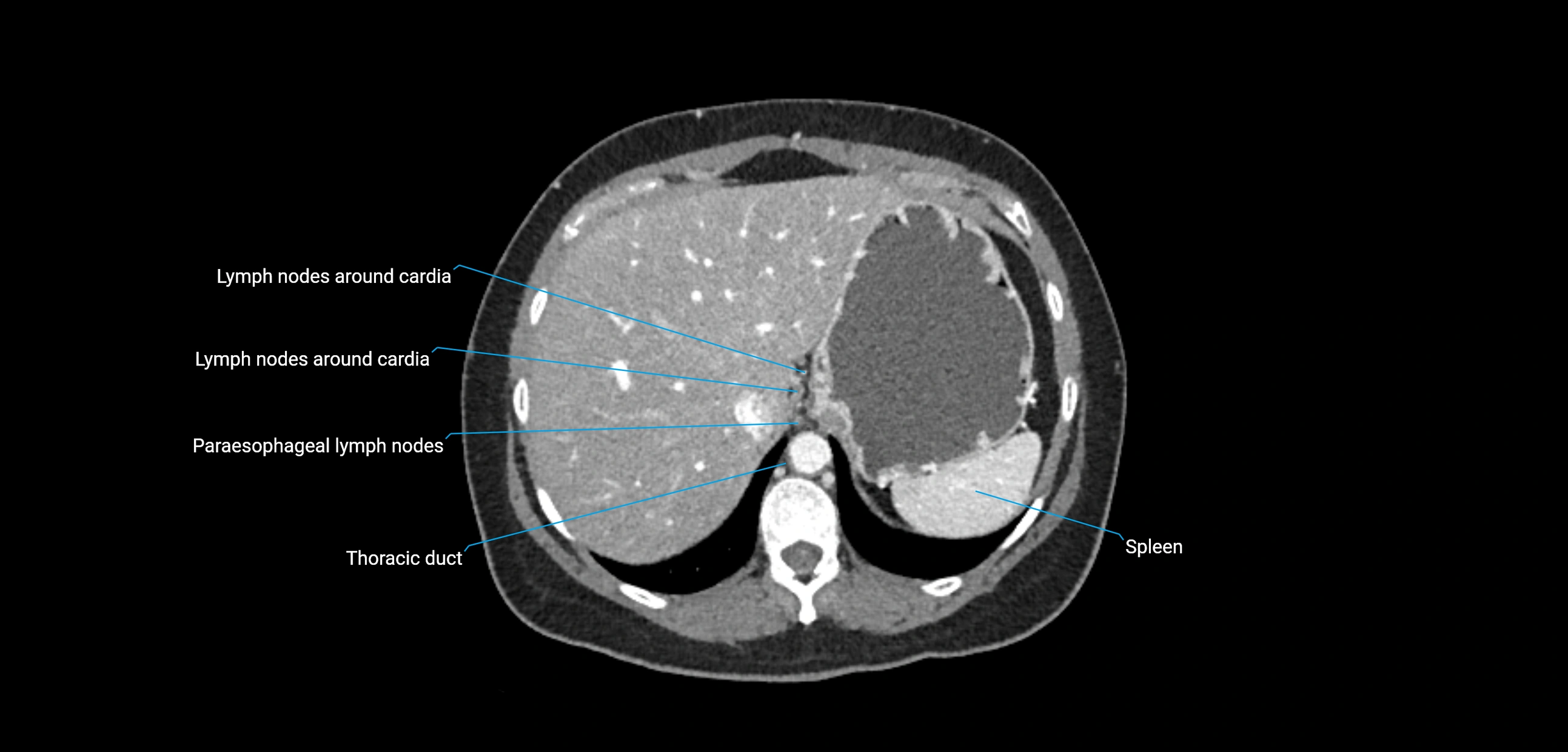 CT ct abdominal lymph nodes  axial cross sectional anatomy  enchanced radiology image -img-00002-00102.webp